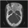 繊維性骨異形成における視神経管の狭窄