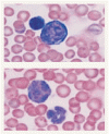 急性 T 細胞性リンパ芽球性白血病における Smad3 の欠失