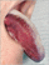 血栓溶解療法後の舌血腫