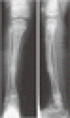 パミドロン酸療法による X 線写真上の縞状の線