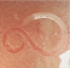 セイロン鉤虫の腸管感染
