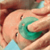 新生児陰茎包皮環状切除術