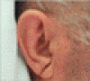 両側の耳朶皺襞