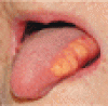 舌の対称性脂肪腫