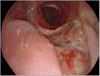 同種気管移植片の内視鏡評価