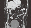 胆囊の経横隔膜性肋間ヘルニア