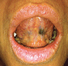 悪性黒色腫との鑑別に難渋した口腔内のアマルガム色素沈着