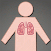 COPD の増悪を減少させる