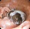 悪性黒色腫の十二指腸転移