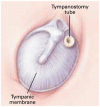 中耳腔換気用チューブ挿入の転帰における，補助的アデノイド切除術と扁桃切除術の役割