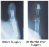 組織工学で作った骨を用いた剥離指節骨の置換