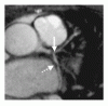 冠動脈狭窄の検出を目的とした磁気共鳴冠動脈造影法