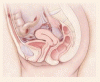 薬物療法：子宮内膜症の治療