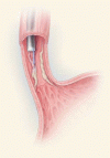 医学の進歩：胃食道静脈瘤出血