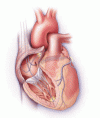 心不全における心臓の再同期療法