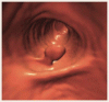 無症状の成人における大腸新生物スクリーニングのためのCT 仮想大腸内視鏡