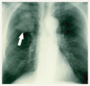 肺癌の集学的管理