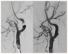 頸動脈ステント留置術と頸動脈内膜剥離術の比較
