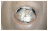 造血器腫瘍の強化療法後の口腔粘膜炎に対するパリフェルミン