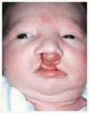 口唇裂・口蓋裂に対する遺伝的感受性
