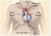 移植までのつなぎとしての全置換型人工心臓