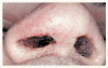鼻のうっ血，腫脹，および痛みを呈する男性