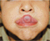 舌の粘液嚢腫