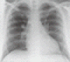 肺塞栓症のウェスターマーク徴候