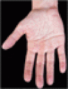 嚢胞線性維症における手掌の水原性のしわ
