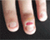 指の化膿性肉芽腫