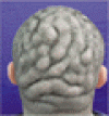 脳回状頭皮