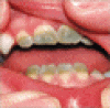 新生児敗血症における緑色歯