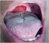 口蓋垂血管性浮腫