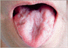 筋萎縮性側索硬化症における舌の線維束性攣縮
