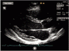 大動脈弁の画像検査