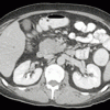 発熱と菌血症を呈する男性の連続 CT 画像