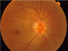 網膜の検査