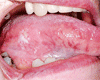 舌の扁平上皮癌