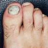 爪床近位の白色爪真菌症として現れる HIV 感染症