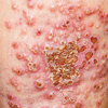 ヘルペス性湿疹