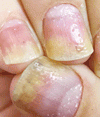 乾癬における爪の点状陥凹