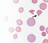 血栓性血小板減少性紫斑病