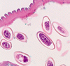 Enterobius vermicularis（蟯虫）感染