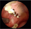 耳下腺管から噴出する唾液