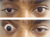 眼瞼のカーテン徴候