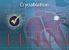 心房細動に対するクライオアブレーションと薬物療法との比較