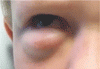 眼窩横紋筋肉腫