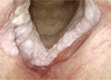 喉頭カンジダ症