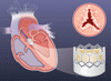 無症状の重度大動脈弁狭窄症に対する早期 TAVR